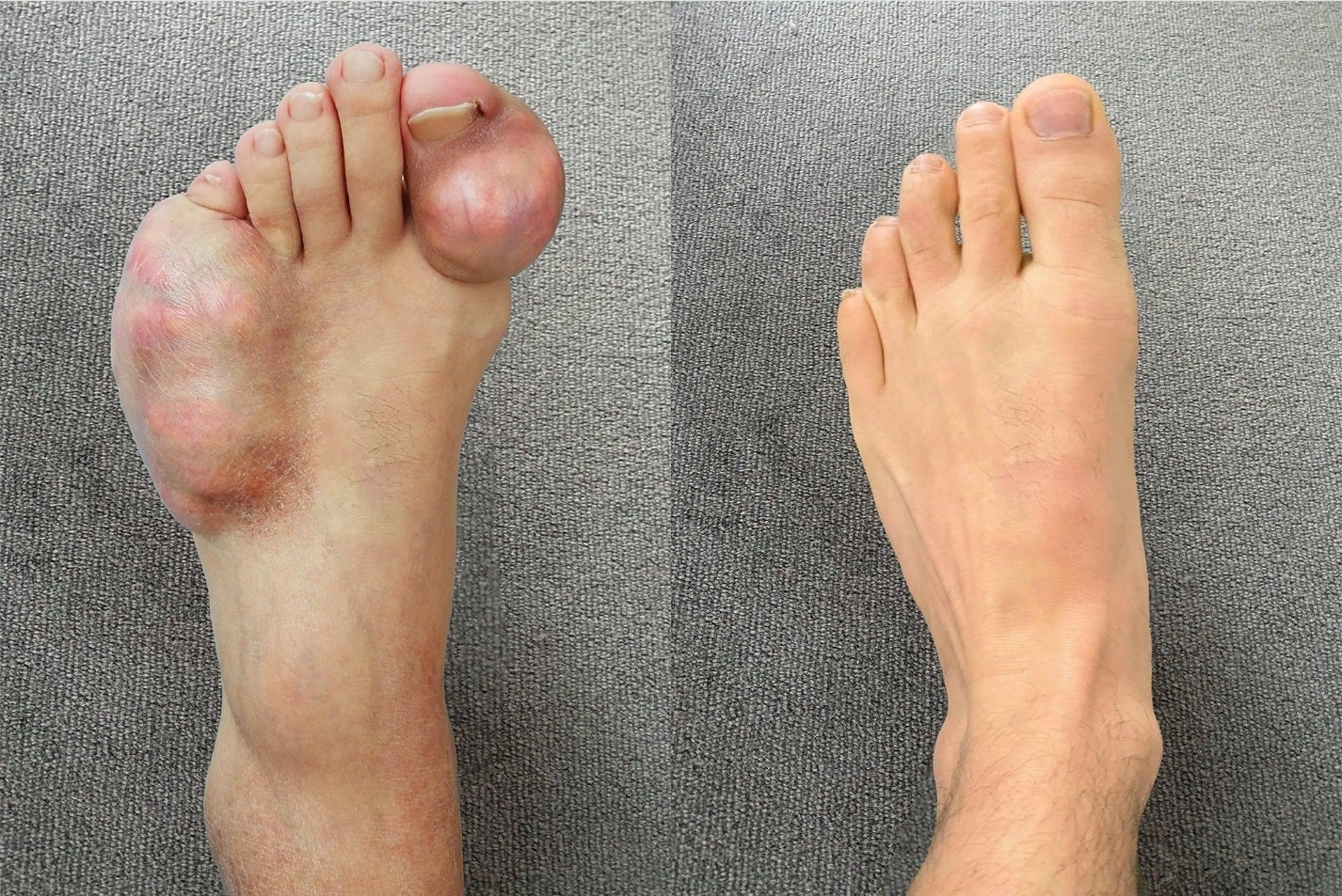 Confort articulaire pieds — avant/après CurcFlex