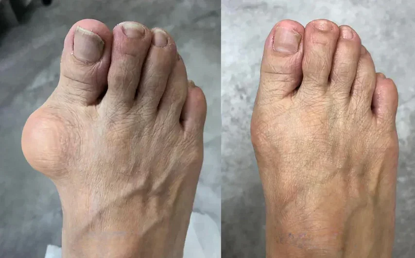 Confort articulaire pieds — avant/après CurcFlex