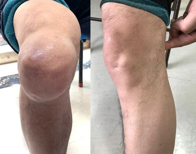 Genou plus confortable — avant/après CurcFlex